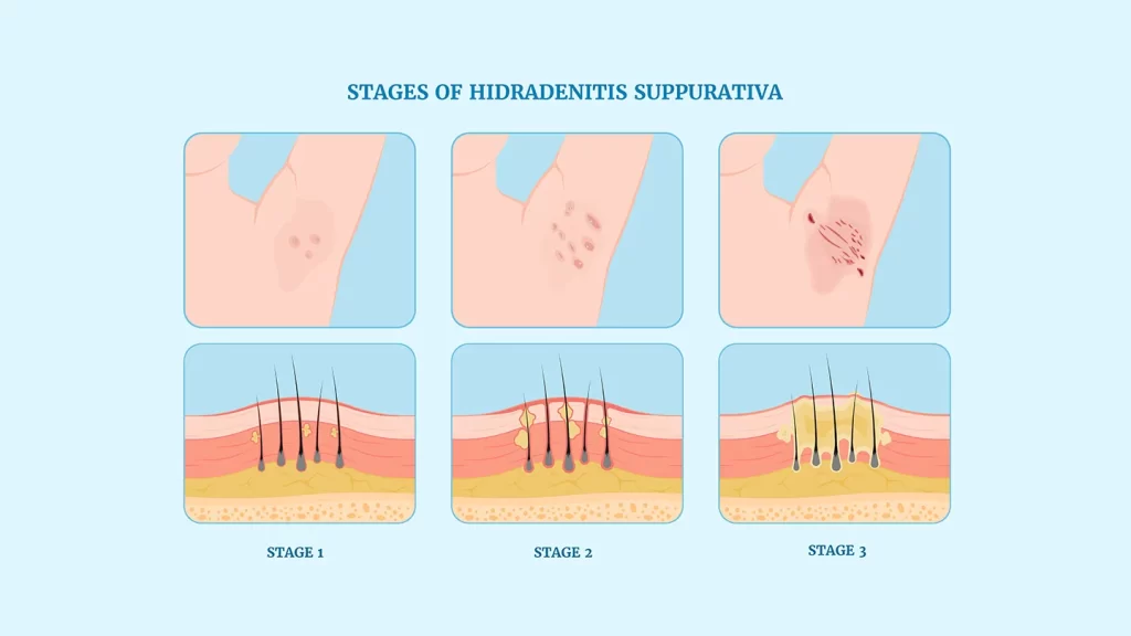 a imagem descreve os estágios da hidrdenitis suppurativa.