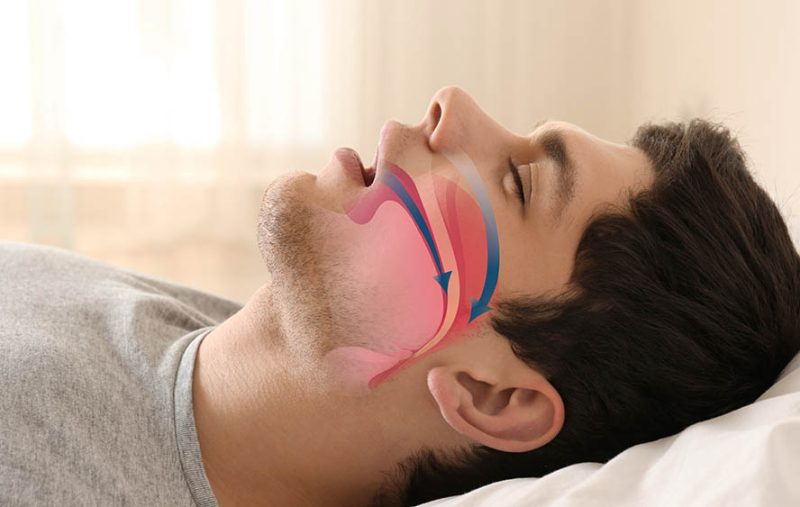 Apneia do sono: 7 fatos que você precisa saber sobre o distúrbio que afeta milhões de brasileiros