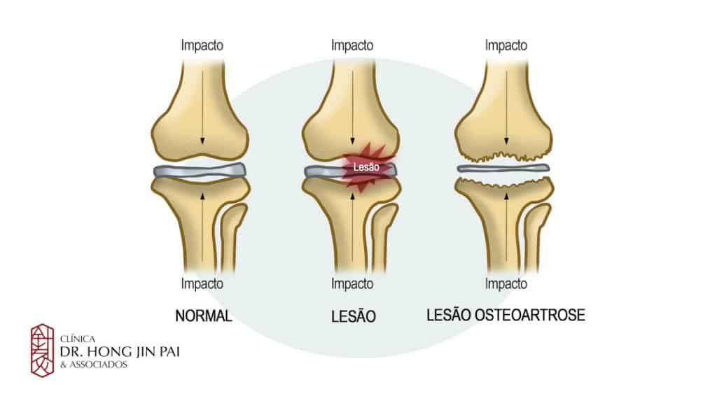 A osteoartrose pode passar despercebida ou ser confundida com dores musculares.
